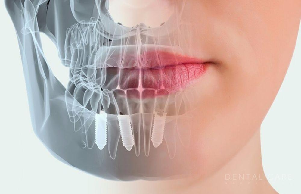 Cirugía guiada con planificación digital