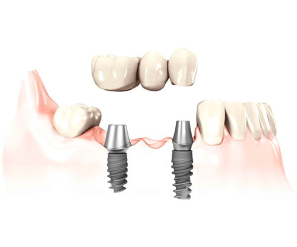 Rehabilitación sobre implantes