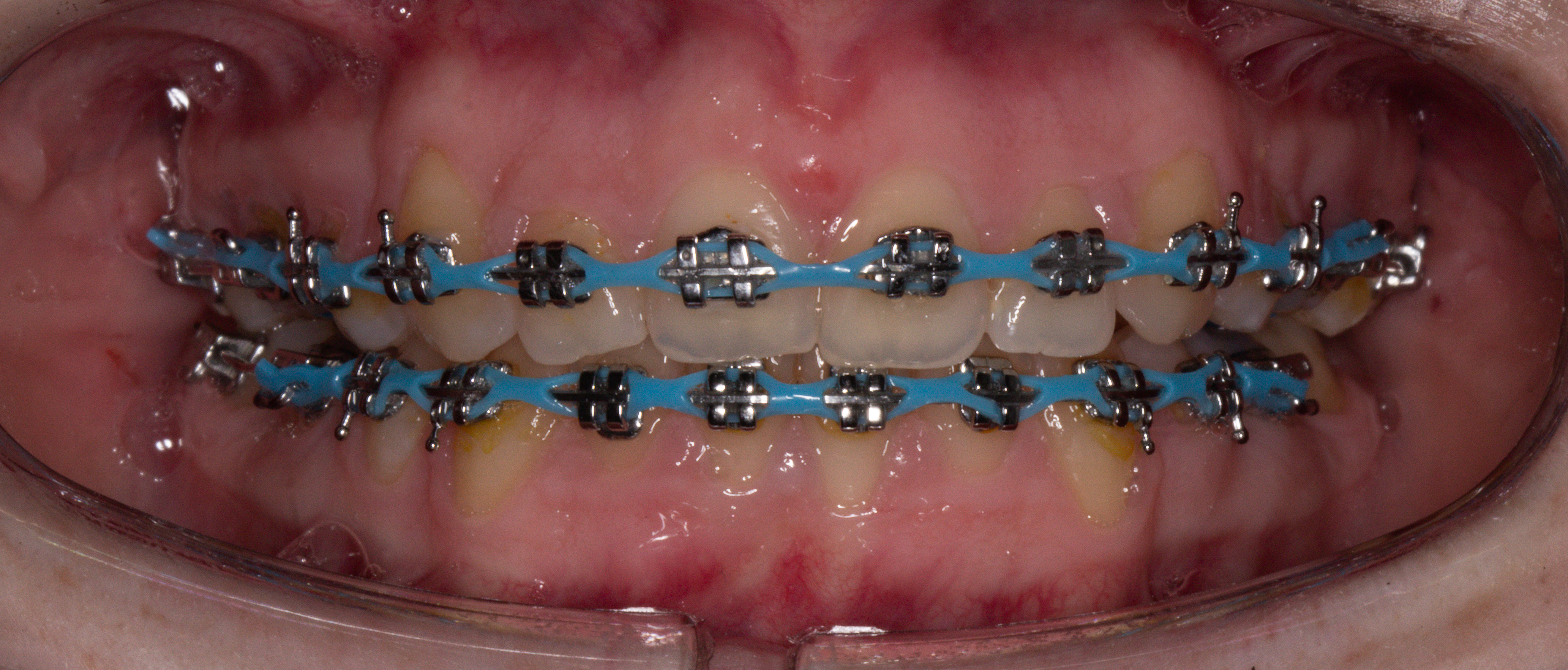 Colocación de brackets