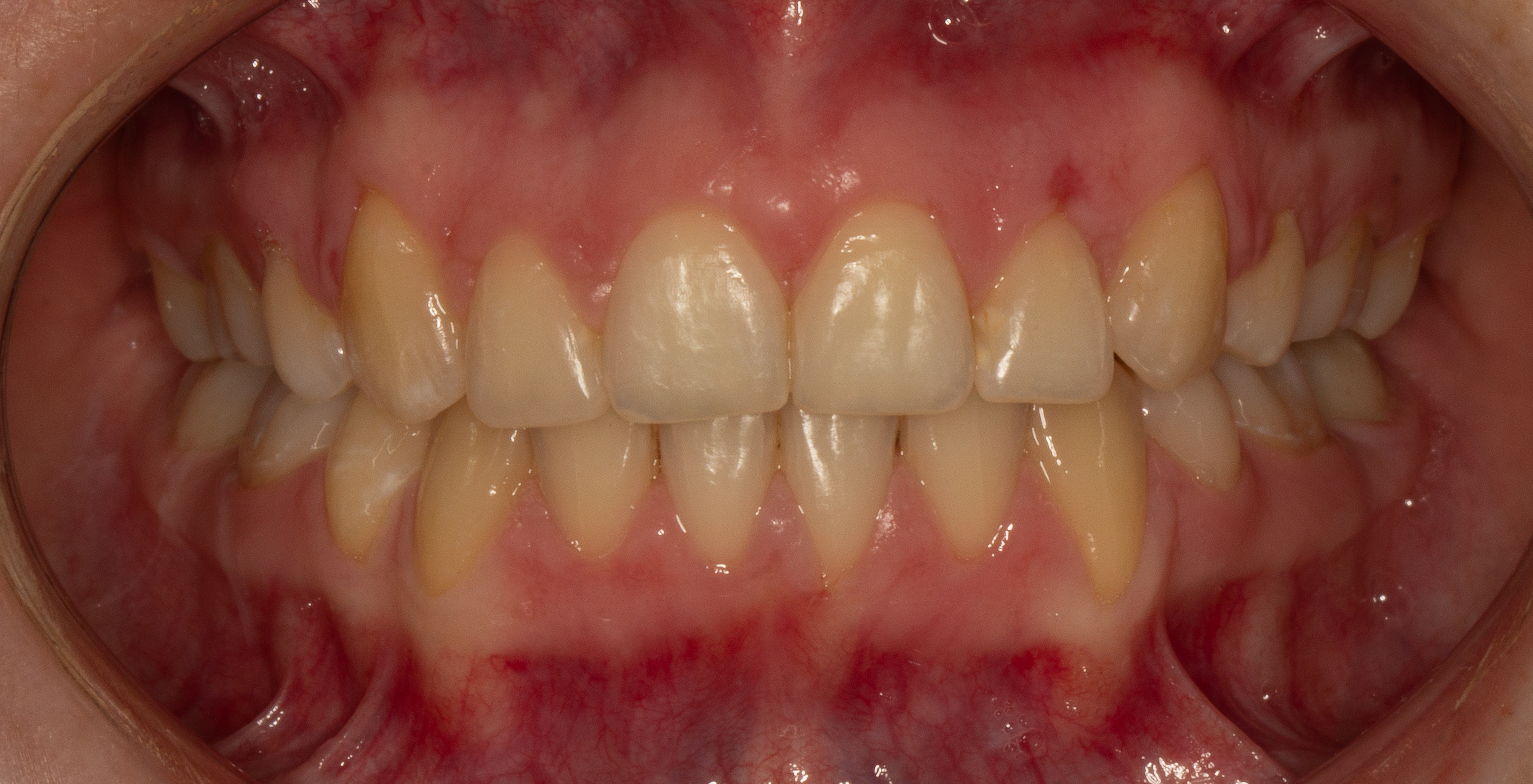 Resultado final de ortodoncia